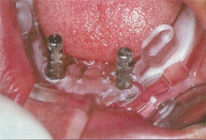 Border-Lock Implantat-OK-Löffel-Set, tansparent für bezahnte Kiefer,