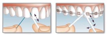 Mirafloss Implant, fine oder medium, im Spender, je 1 Stück
