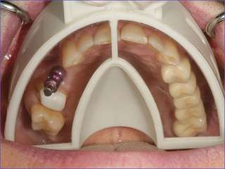 Miratray Implantat Abformlöffel mit Folientechnik im Set oder je 6 Stück