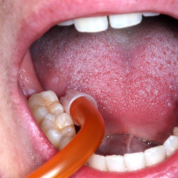 Medicom Speichelsauger mit abnehmbarer Kappe, 15 cm lang, verschiedene Farben, je 100 Stück