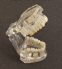 KKD Studienmodell für Zahnkrankheiten, transparent 09445